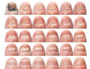 Gradual damage to nail with a fungus