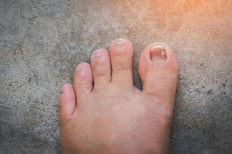 Nail fungus