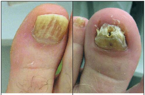 Normotrophic fungus type
