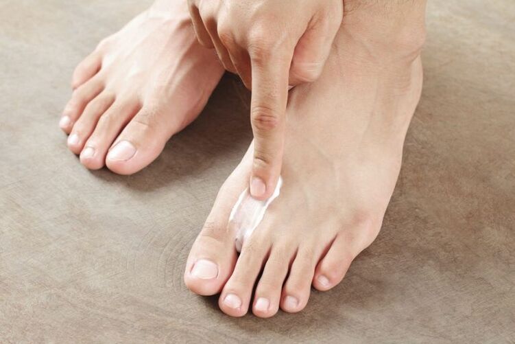 Application of antimicotic cream to foot skin