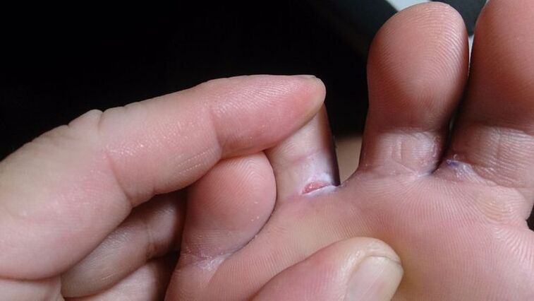 Fungus between the fingers