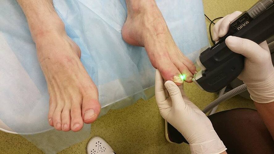 Toenail Fungus Laser Treatment