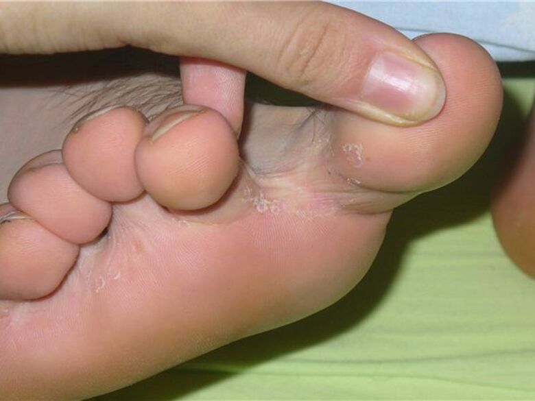 Fungus between the fingers