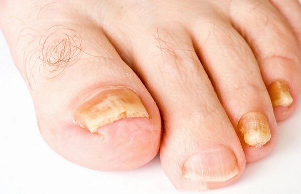Nail fungus forms