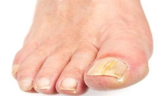 Yellowing of the nails due to a fungal infection.