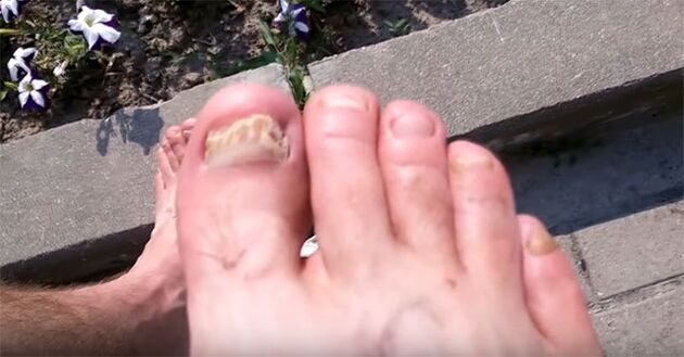 fungal toenail
