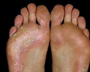 fungal foot injury