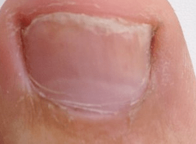 photo of the initial stage of toenail fungus