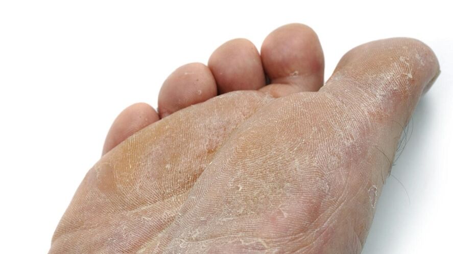 foot fungus symptoms