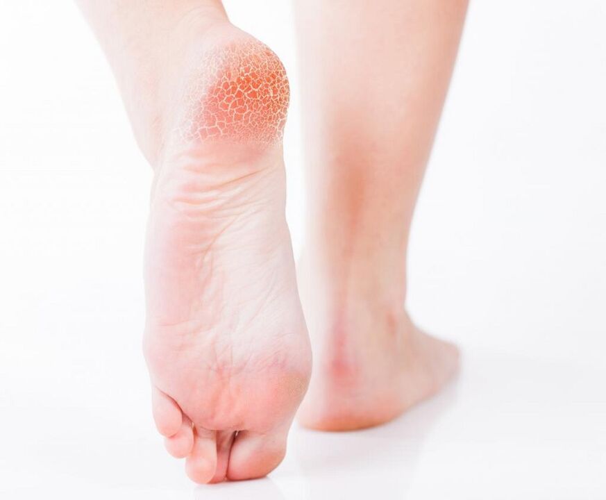 fungal foot infection