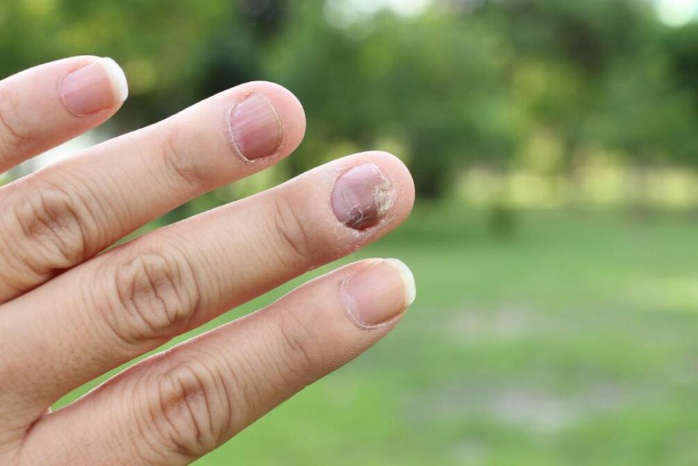 nail fungus