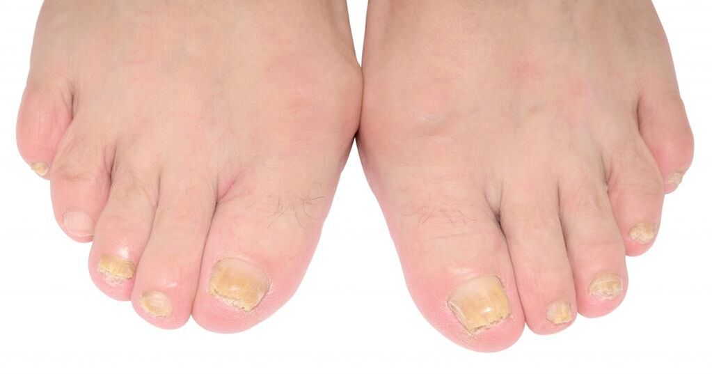 signs of toenail fungus