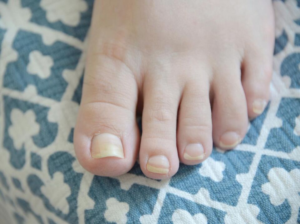 toenail fungus