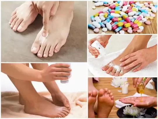Ways to treat fungus between the toes.