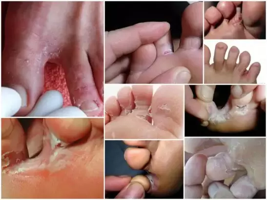 symptoms of fungus between the fingers photo 1
