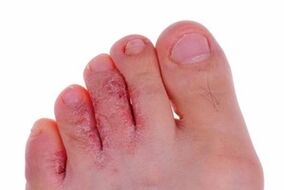 Skin lesions due to fungus on the legs.