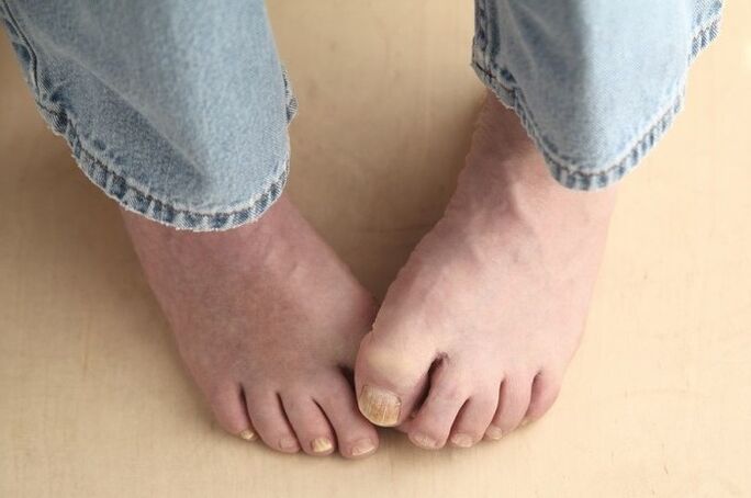 Feet with nails affected by fungus. 