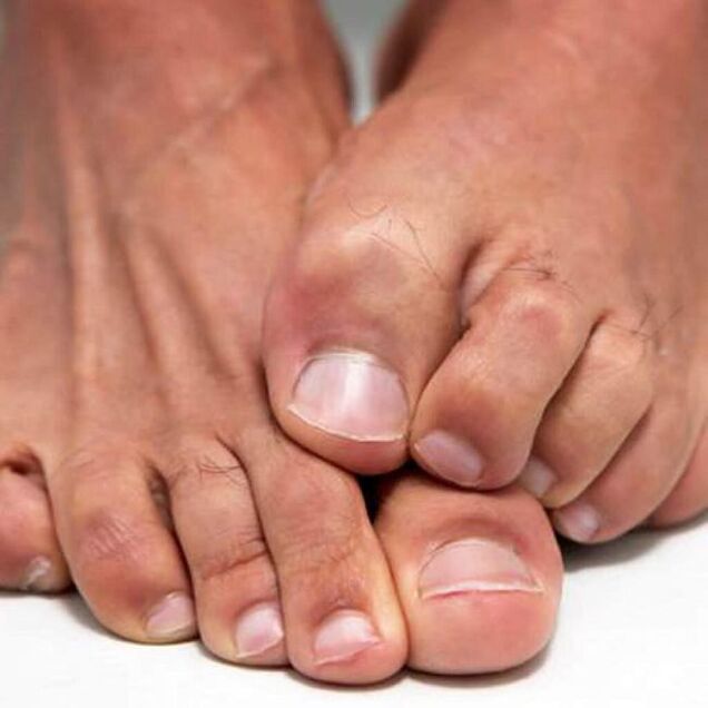 Foot fungus can cause itching. 