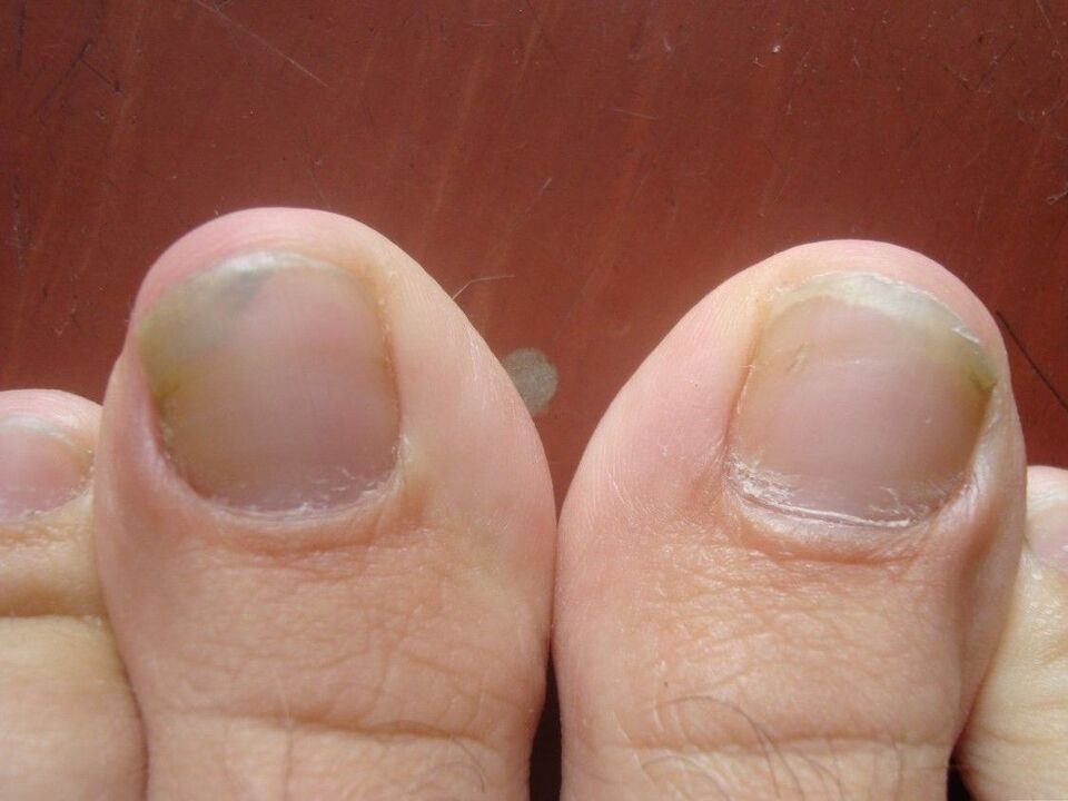 Symptoms and causes of nail fungus. 