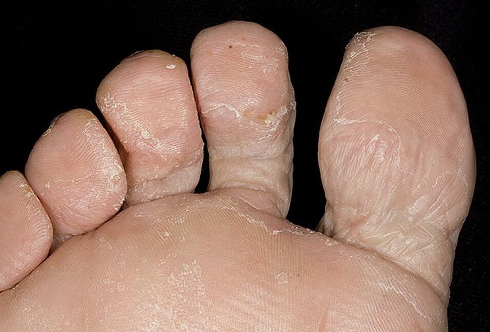 Fungus between the toes