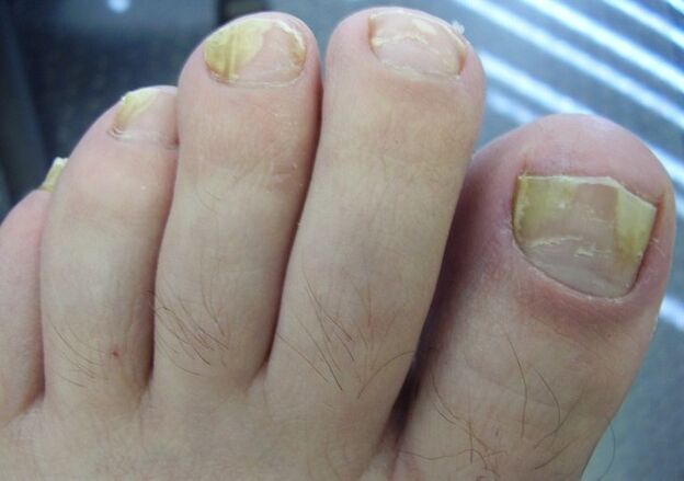 Toenails affected by fungus. 